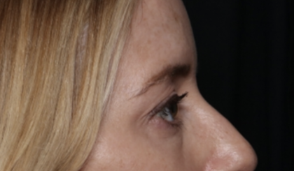 Upper Blepharoplasty Before & After Patient #35792
