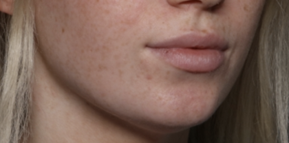 Lip Filler Before & After Patient #35782