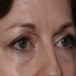 Lower Blepharoplasty Before & After Patient #35834