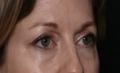 Lower Blepharoplasty Before & After Patient #35834