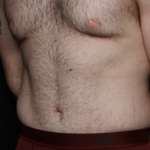 Tummy Tuck Before & After Patient #35790