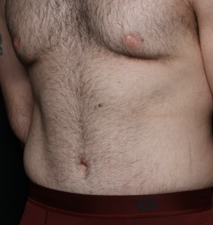 Tummy Tuck Before & After Patient #35790