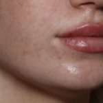 Lip Filler Before & After Patient #35782