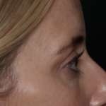 Upper Blepharoplasty Before & After Patient #35792