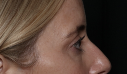 Upper Blepharoplasty Before & After Patient #35792