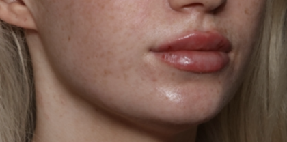 Lip Filler Before & After Patient #35782