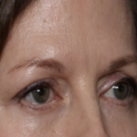 Lower Blepharoplasty Before & After Patient #35834