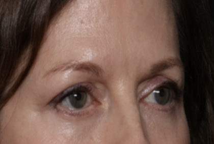 Lower Blepharoplasty Before & After Patient #35834