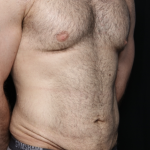 Tummy Tuck Before & After Patient #35790