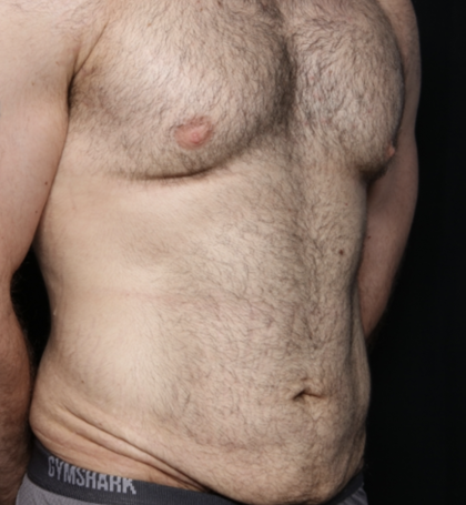 Tummy Tuck Before & After Patient #35790
