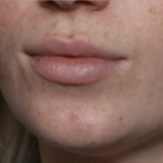 Lip Filler Before & After Patient #35782