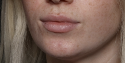 Lip Filler Before & After Patient #35782