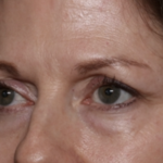 Lower Blepharoplasty Before & After Patient #35834