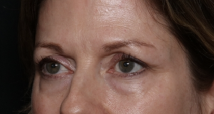 Lower Blepharoplasty Before & After Patient #35834