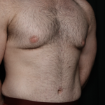 Tummy Tuck Before & After Patient #35790