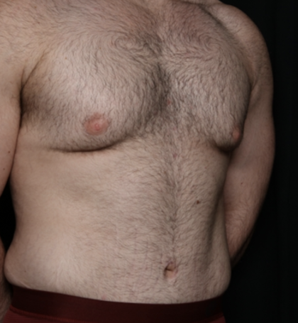 Tummy Tuck Before & After Patient #35790