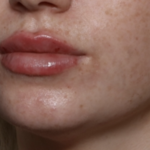 Lip Filler Before & After Patient #35782