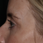 Upper Blepharoplasty Before & After Patient #35792