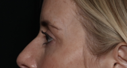 Upper Blepharoplasty Before & After Patient #35792