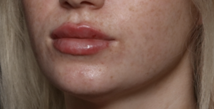 Lip Filler Before & After Patient #35782