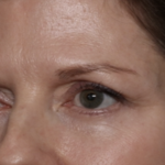 Lower Blepharoplasty Before & After Patient #35834