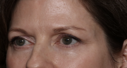 Lower Blepharoplasty Before & After Patient #35834