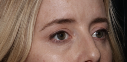 Upper Blepharoplasty Before & After Patient #35792