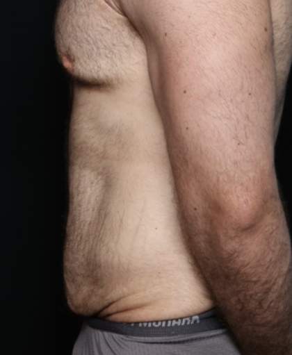 Tummy Tuck Before & After Patient #35790