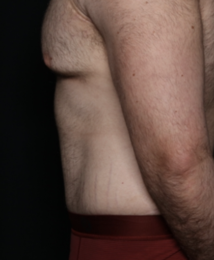 Tummy Tuck Before & After Patient #35790