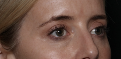 Upper Blepharoplasty Before & After Patient #35792