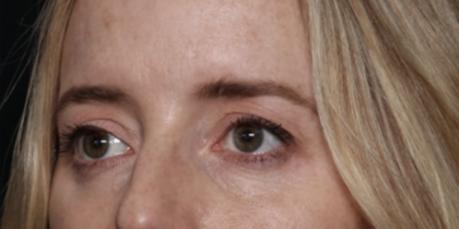 Upper Blepharoplasty Before & After Patient #35792