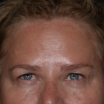 Upper Blepharoplasty Before & After Patient #35835