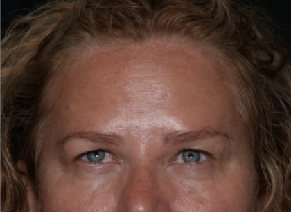 Upper Blepharoplasty Before & After Patient #35835