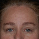 Upper Blepharoplasty Before & After Patient #35835