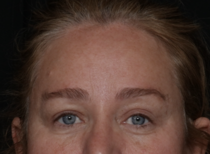 Upper Blepharoplasty Before & After Patient #35835