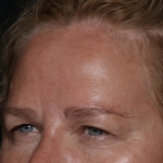 Upper Blepharoplasty Before & After Patient #35835