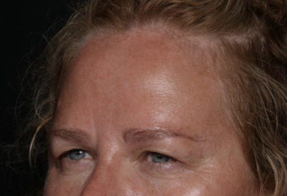 Upper Blepharoplasty Before & After Patient #35835
