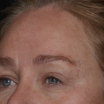 Upper Blepharoplasty Before & After Patient #35835