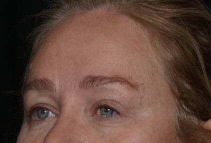Upper Blepharoplasty Before & After Patient #35835