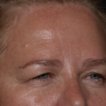 Upper Blepharoplasty Before & After Patient #35835