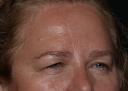 Upper Blepharoplasty Before & After Patient #35835