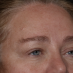 Upper Blepharoplasty Before & After Patient #35835
