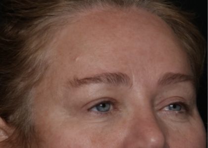 Upper Blepharoplasty Before & After Patient #35835