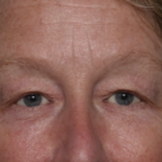 Upper Blepharoplasty Before & After Patient #35771