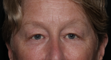 Upper Blepharoplasty Before & After Patient #35771