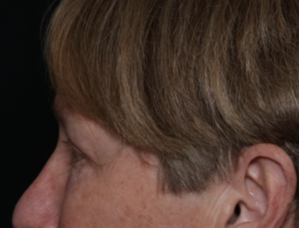 Upper Blepharoplasty Before & After Patient #35771