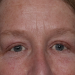 Upper Blepharoplasty Before & After Patient #35771