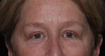 Upper Blepharoplasty Before & After Patient #35771