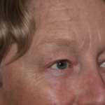 Upper Blepharoplasty Before & After Patient #35771