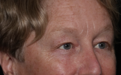 Upper Blepharoplasty Before & After Patient #35771